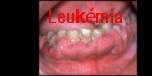 Április 30-án, a Kultiplexben, hosszú évek után ismét koncertet ad a kilencvenes évek egyik kultuszcsapata, a Leukémia